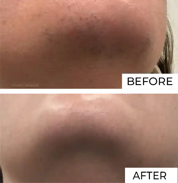 Hair Removal Before After (1)
