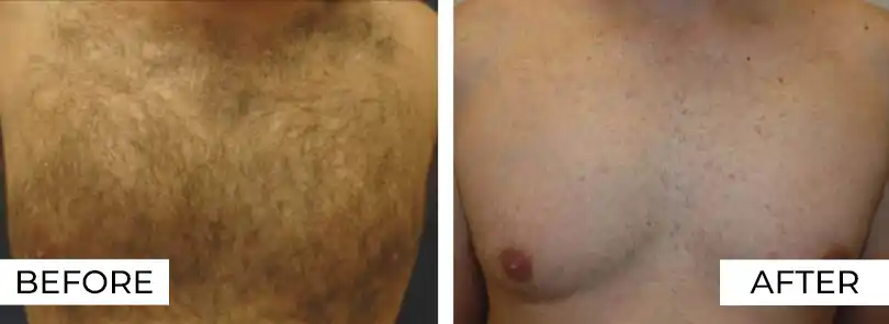 Hair Removal Before After (2)