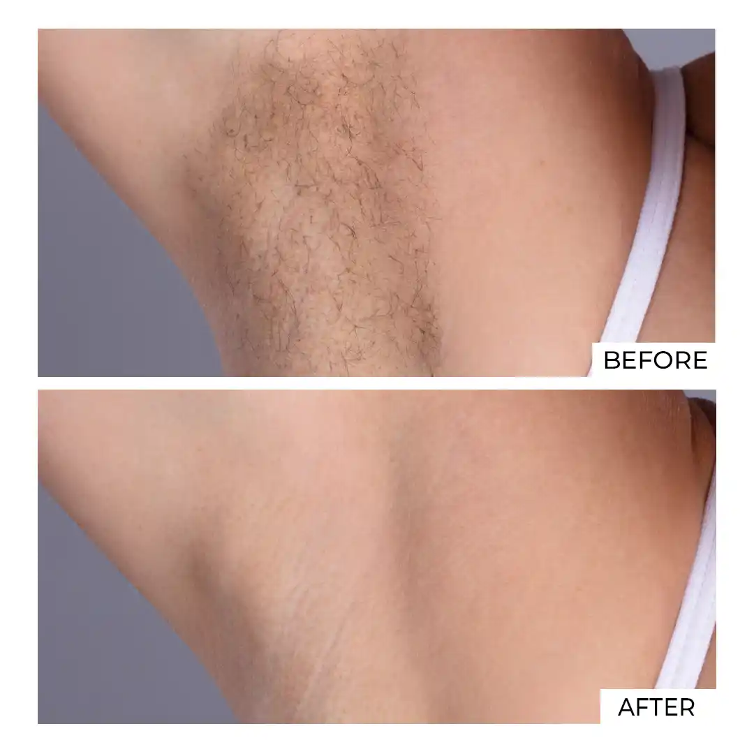 Hair Removal Before After (3)