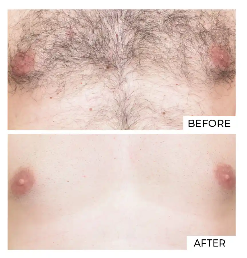 Hair Removal Before After (4)
