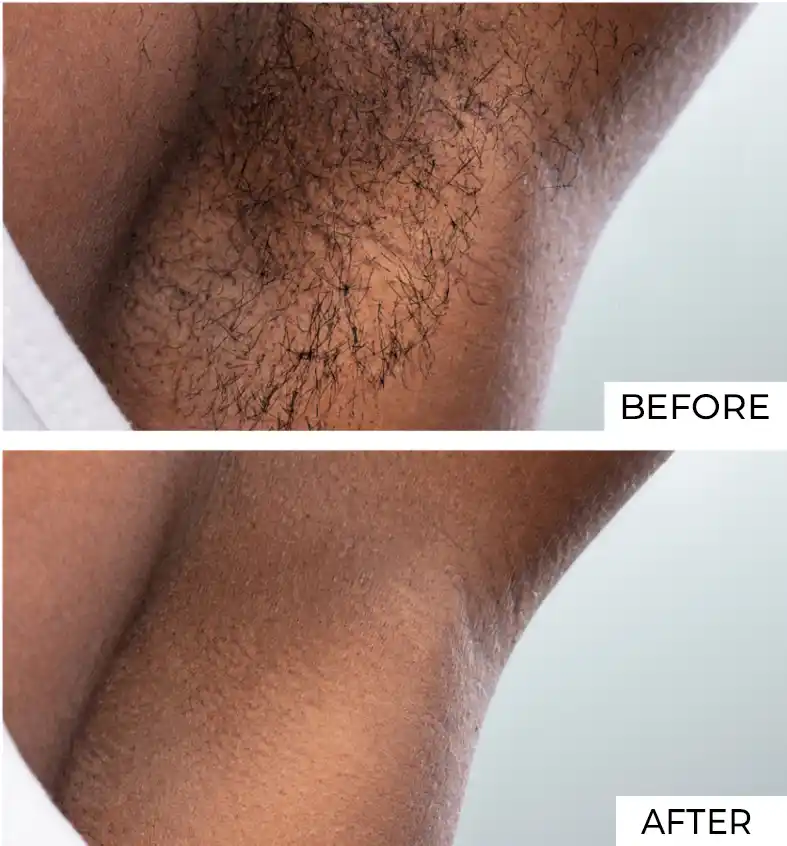Hair Removal Before After (5)