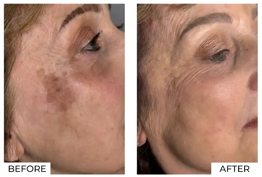 IPL Before and After (1)