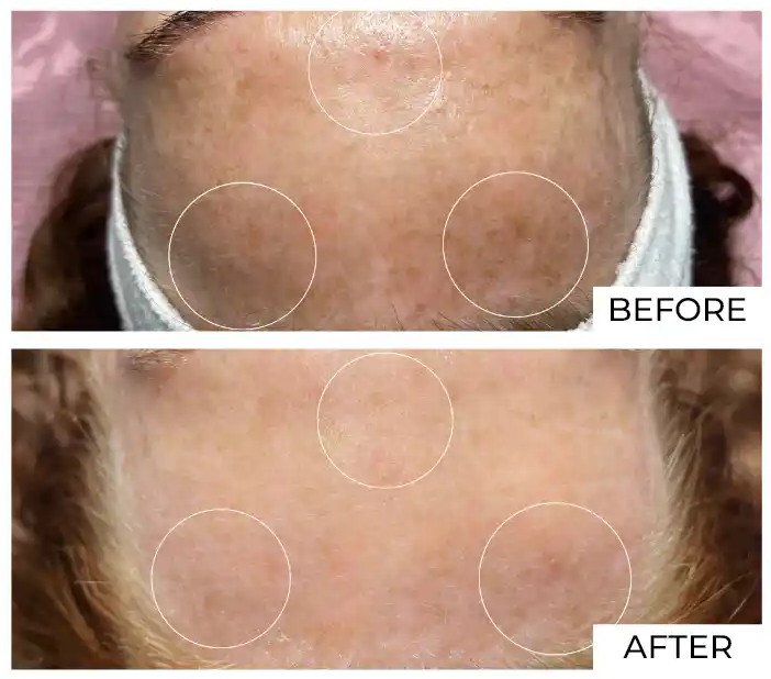 IPL Before and After (2)