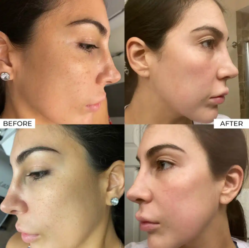 IPL Before and After (3)