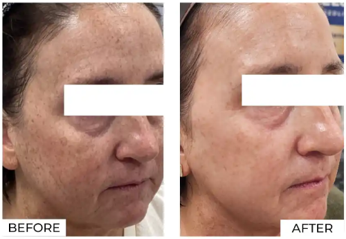 IPL Before and After (4)