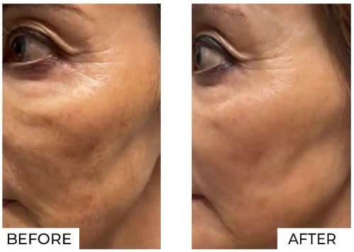 IPL Before and After (5)