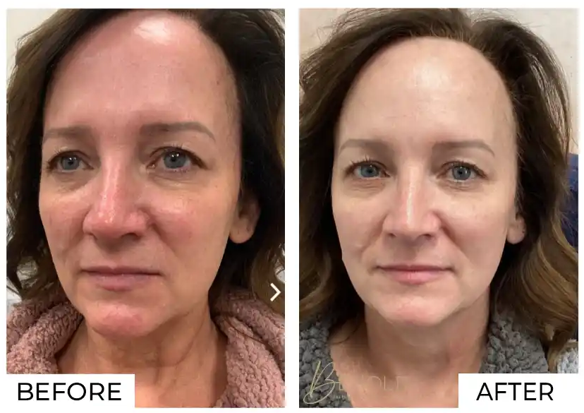 IPL Before and After (6)