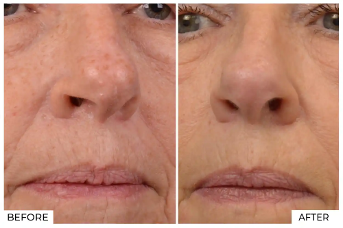 IPL Before and After (7)