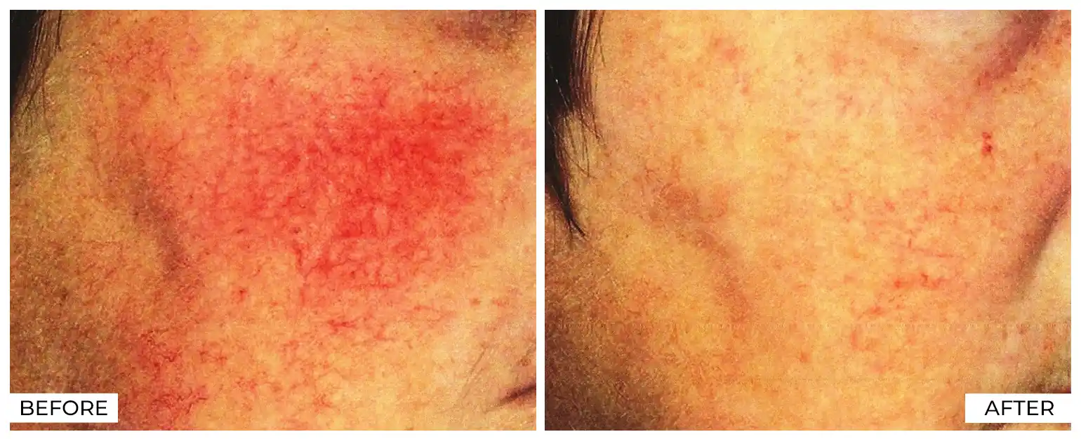 IPL Before and After