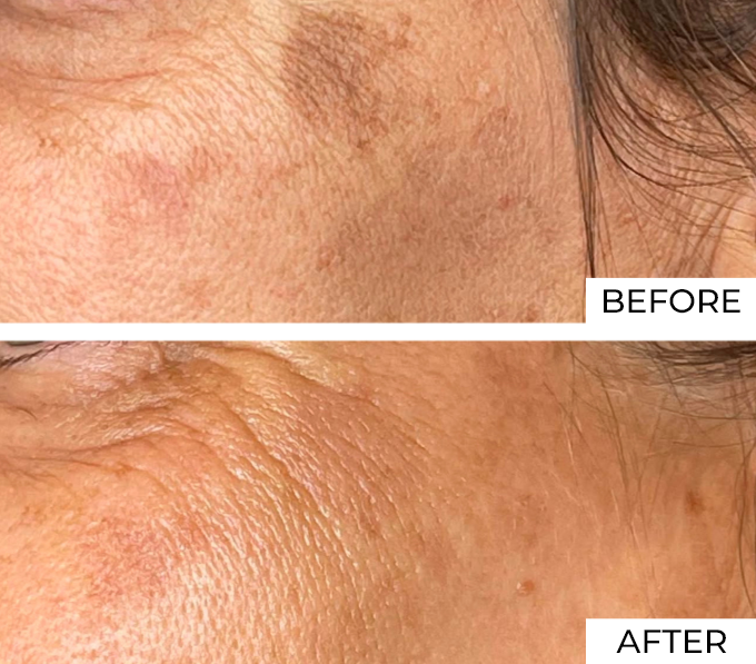 Long Pulse YAG Before After (1)