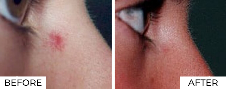 Long Pulse YAG Before After (2)