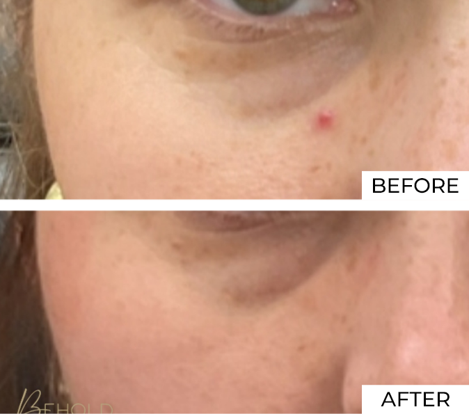 Long Pulse YAG Before After (3)