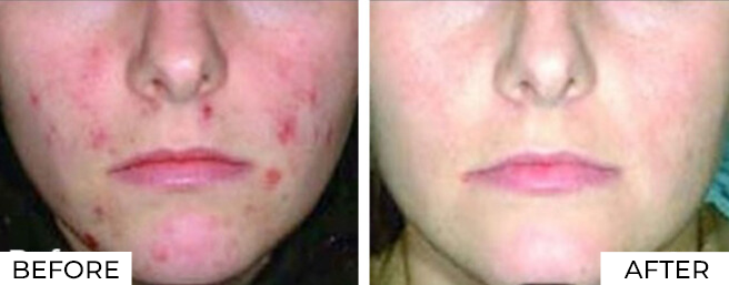 Long Pulse YAG Before After