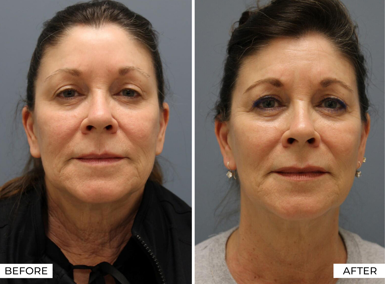 RF Microneedling-Before & After (10)