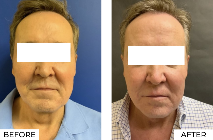 RF Microneedling-Before & After (11)