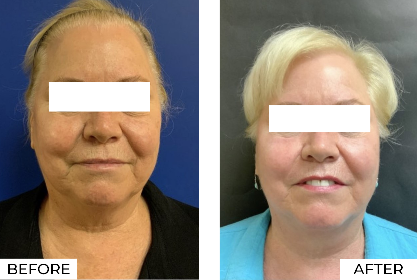 RF Microneedling-Before & After (12)