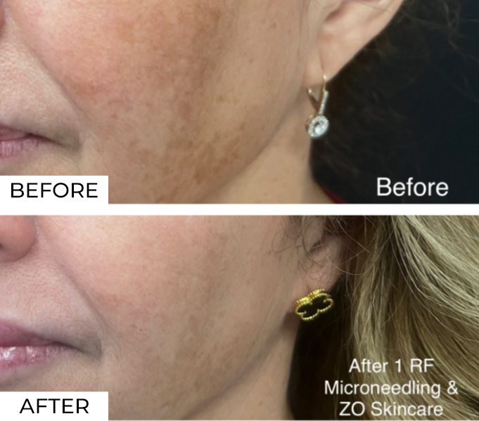 RF Microneedling-Before & After (13)