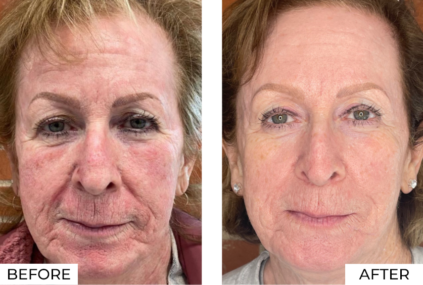 RF Microneedling-Before & After (14)