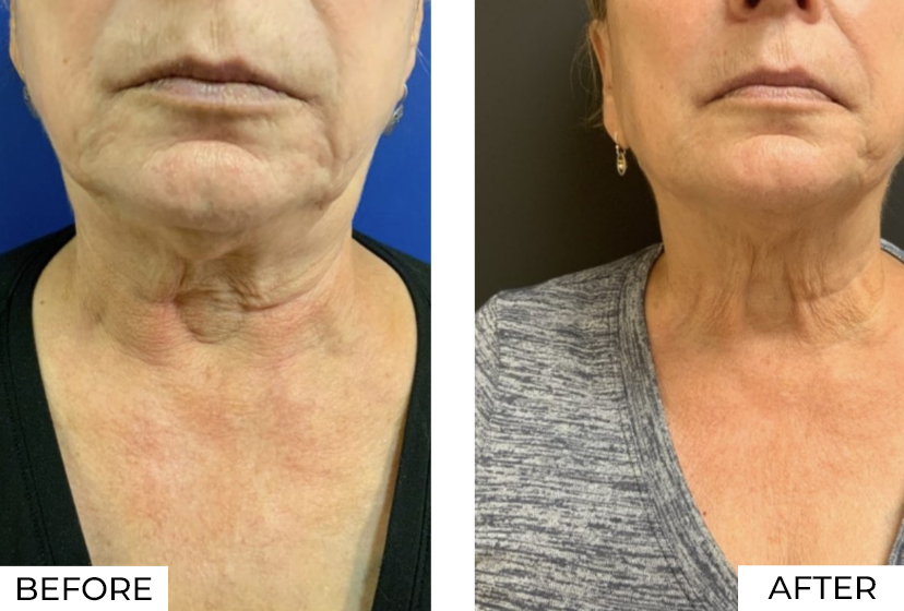 RF Microneedling-Before & After (15)