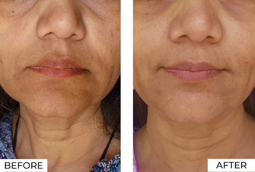 RF Microneedling-Before & After (4)
