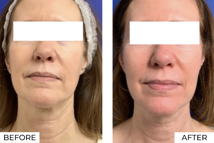 RF Microneedling-Before & After (5)