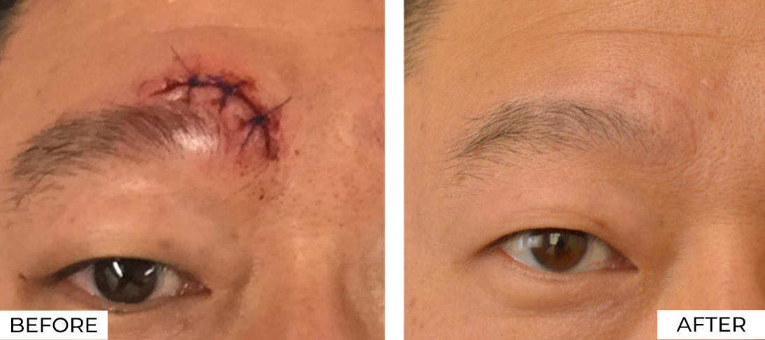 RF Microneedling-Before & After (6)