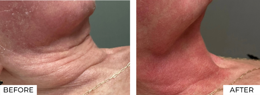 RF Microneedling-Before & After (8)