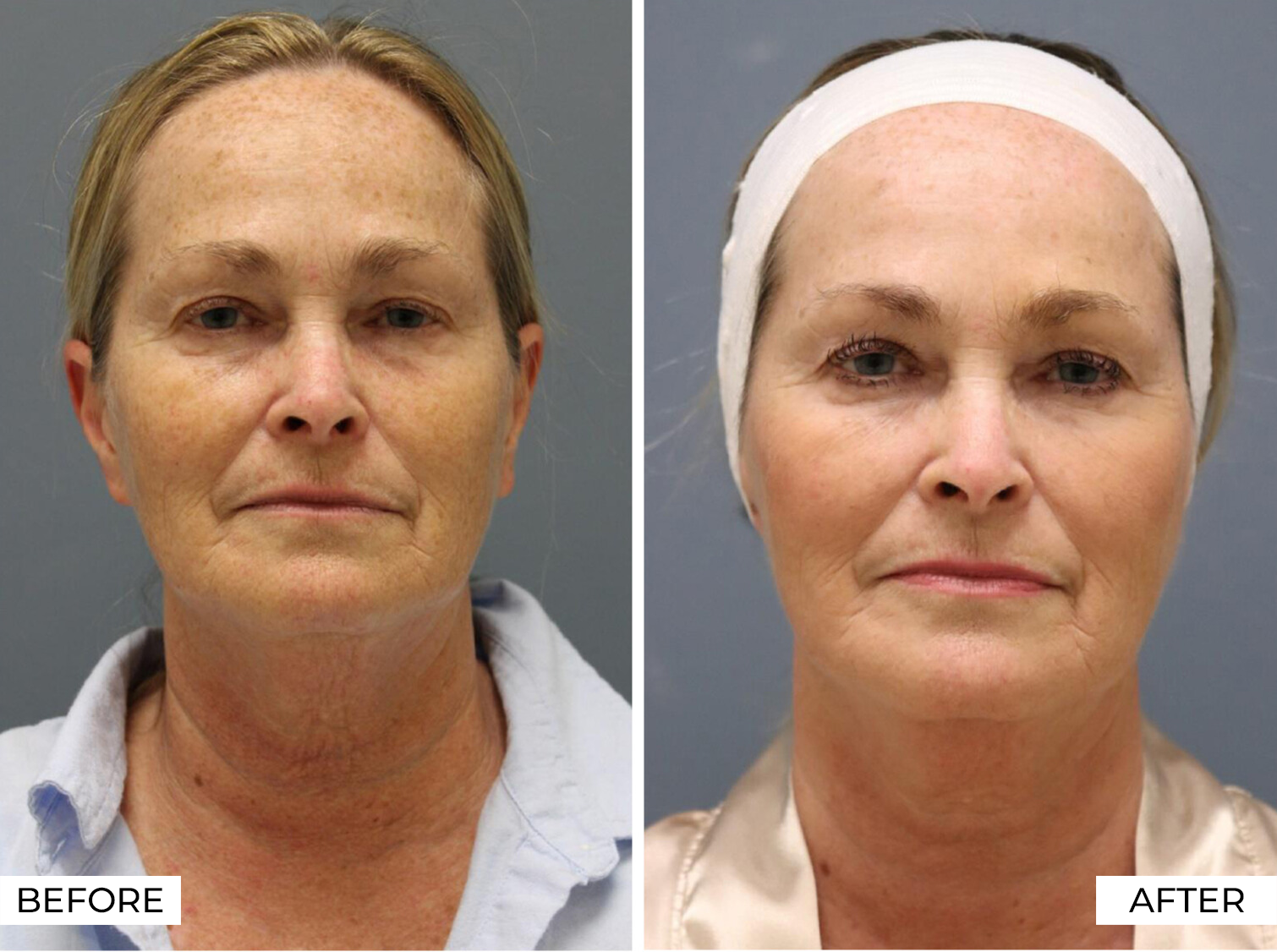 RF Microneedling-Before & After (9)