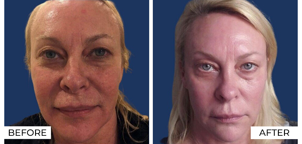 Skin resurfacing Before and after (1)