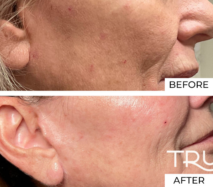 Skin resurfacing Before and after (2)
