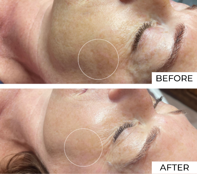 Skin resurfacing Before and after (3)
