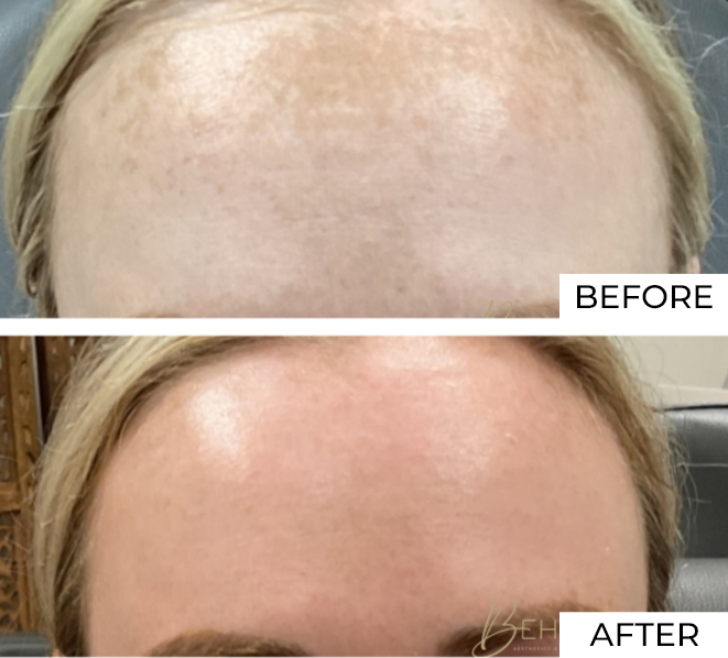 Skin resurfacing Before and after (4)