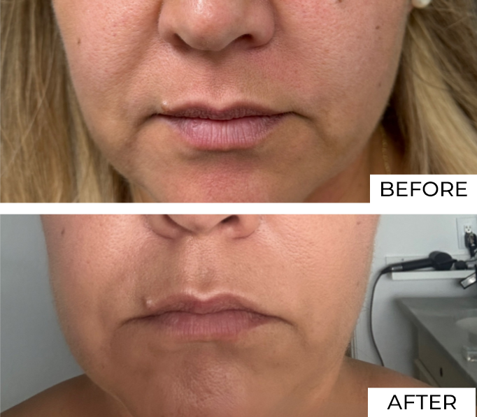 Skin resurfacing Before and after (5)