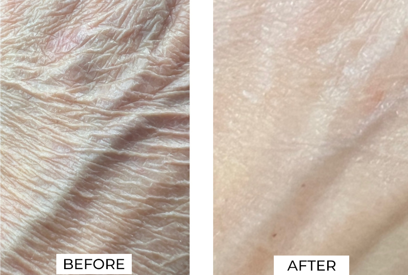 Skin resurfacing Before and After (6)