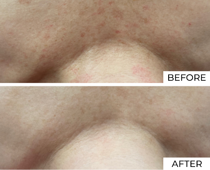 Skin resurfacing Before and After