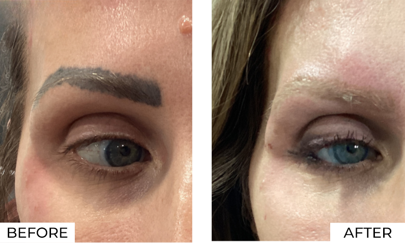 Tattoo Removal Before After (2)