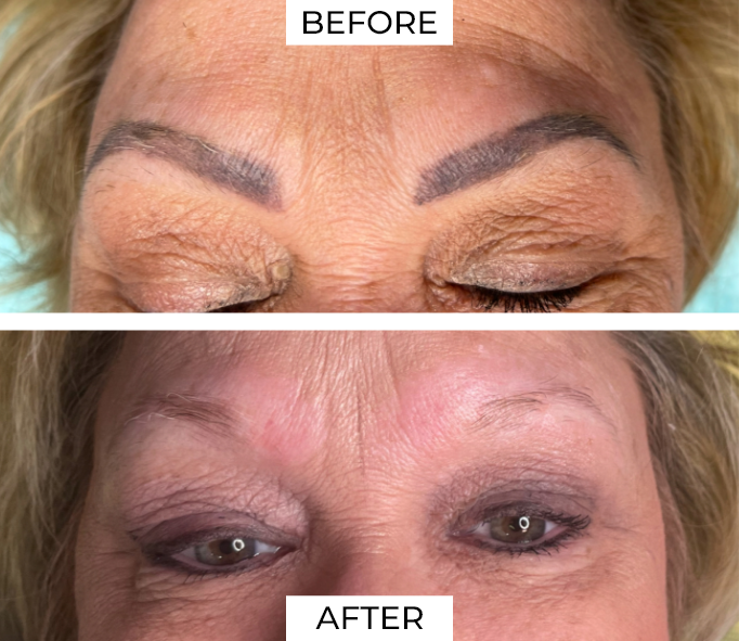 Tattoo Removal Before After